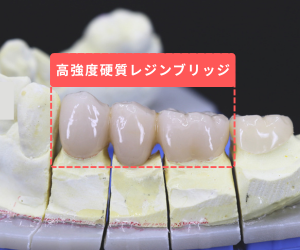 高強度硬質レジンブリッジ