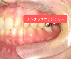ノンクラススプデンチャーを入れたときの口内画像